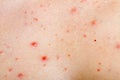 Human skinwith acne Royalty Free Stock Photo