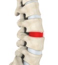 Human Spine Disc Degenerative