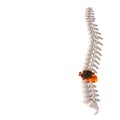 Human spine with disc herniation concept Royalty Free Stock Photo