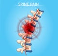 Human Spine Pain Realistic Vector Medical Scheme Royalty Free Stock Photo