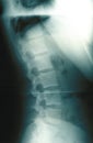 Human Spine Xray Royalty Free Stock Photo