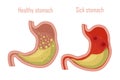 Human stomach, digestive system. A healthy and sick stomach. Vector illustration