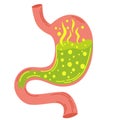 Human stomach. Gastritis and acid reflux, indigestion, vomiting, heartburn and stomach pain problems. Unhealthy stomach concept. Royalty Free Stock Photo