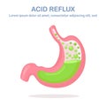 Human stomach. Gastroesophageal reflux disease. GERD, heartburn, gastric infographic. Acid moving up into the esophagus. Vector