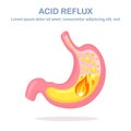 Human stomach. Gastroesophageal reflux disease. GERD, heartburn, gastric infographic. Acid moving up into the esophagus. Vector