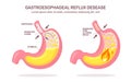 Human stomach. Gastroesophageal reflux disease. GERD, heartburn, gastric infographic. Acid moving up into the esophagus. Vector Royalty Free Stock Photo