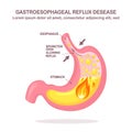 Human stomach. Gastroesophageal reflux disease. GERD, heartburn, gastric infographic. Acid moving up into the esophagus. Vector Royalty Free Stock Photo