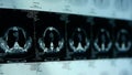 Human subclavian pet-ct scan,lymph nodes X-ray,Cancer metastasis.