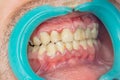 Human teeth closeup with dental plaque and inflammation of gingivitis. Concept of brushing teeth and poor hygiene Royalty Free Stock Photo