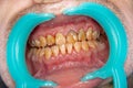 Human teeth closeup with dental plaque and inflammation of gingivitis. Concept of brushing teeth and poor hygiene
