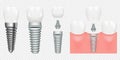 Human teeth and dental implant cut scheme, vector illustration. Dental implant structure with all parts crown, abutment Royalty Free Stock Photo