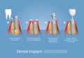 Human teeth and Dental implant