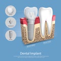 Human teeth and Dental implant Royalty Free Stock Photo