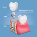 Human teeth and Dental implant