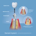 Human teeth and Dental implant