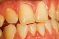 Human teeth, dentistry, teeth whitening, close-up photo. Healthy teeth smile, caries. Orthodontics, toothpaste