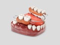 Human teeth with denture. 3d illustration isolated white Royalty Free Stock Photo