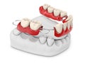 Human teeth with denture. 3d illustration isolated white