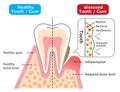 Healthy and diseased gum. dental biofilm. dental and health care concept