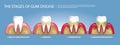 Human teeth Stages of Gum Disease Royalty Free Stock Photo