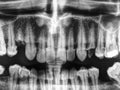 Human teeth xray in black and white Royalty Free Stock Photo