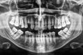 Human teeth xray in black and white Royalty Free Stock Photo
