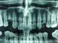Human teeth xray Royalty Free Stock Photo