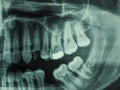 Human teeth xray Royalty Free Stock Photo