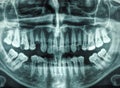 Human teeth xray Royalty Free Stock Photo