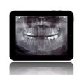 Human Teeths X-ray on the Digital Tablet Royalty Free Stock Photo