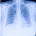 Human thorax x-ray for lungs examination, PA up right. Cancer infected lungs. Virus screening