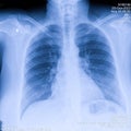 Human thorax x-ray for lungs examination, PA up right. Cancer infected lungs. Virus screening Royalty Free Stock Photo