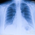 Human thorax x-ray for lungs examination, PA up right. Cancer infected lungs. Virus screening Royalty Free Stock Photo