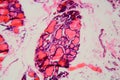 Human thyroid gland with goiter caused by deficiency of iodine under a microscope