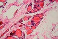 Human thyroid gland with goiter caused by deficiency of iodine under a microscope