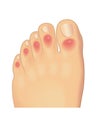 Human toes with chilblains
