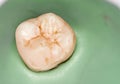 Human Tooth - caries