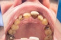 Human tooth decay close-up at the dentist`s appointment. Poor oral hygiene, prevention