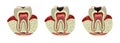 Human tooth decay disease cross section realistic view