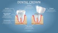 Human tooth and dental crown, vector educational poster Royalty Free Stock Photo