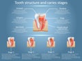 Vector tooth structure diagram and dental caries stages Royalty Free Stock Photo