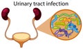 Human Urinary Tract Infection