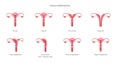 Human uterine malformations. Set of medical charts. Royalty Free Stock Photo