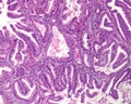 Human uterus. Endometroid carcinoma