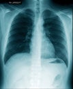 Chest x-ray show inside of lung Royalty Free Stock Photo