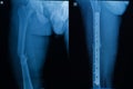human x-rays showing fracture of femur bone