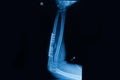 Human x-rays showing fracture of radius bone
