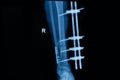 Human x-rays showing fracture of right leg