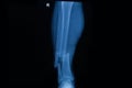 Human x-rays showing fracture of right leg