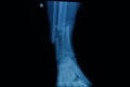 Human x-rays showing fracture of right leg